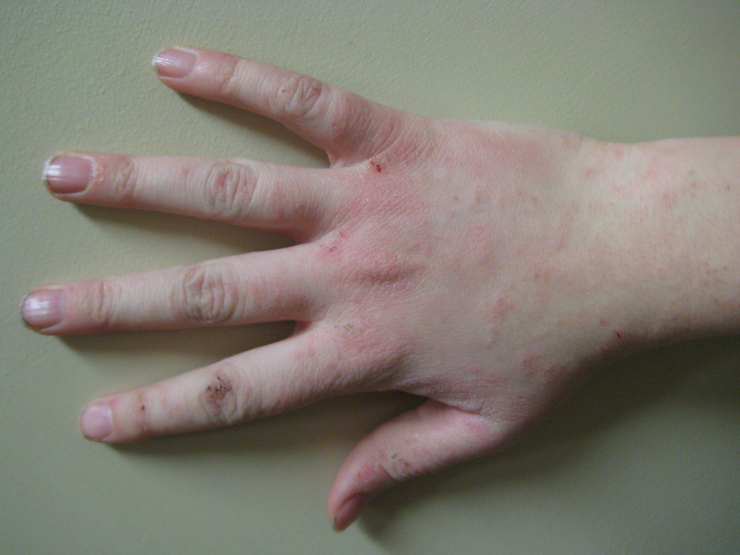 eczema